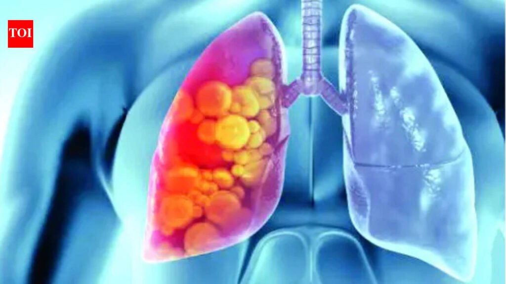 Lung cancer deaths down 16% with low-dose CT screening: IARC | India News